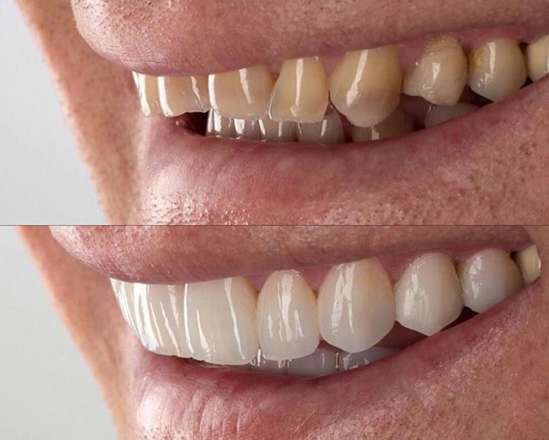 دندانپزشکی کامپوزیت عصبکشی|خدمات آرایشگری و زیبایی|نسیم‌شهر, |دیوار