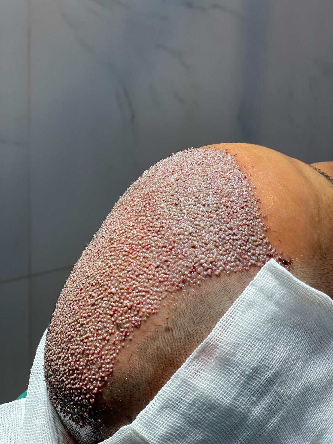 جشنواره  کاشت مو و ابرو شیراز|خدمات آرایشگری و زیبایی|اصفهان, دانشگاه اصفهان|دیوار