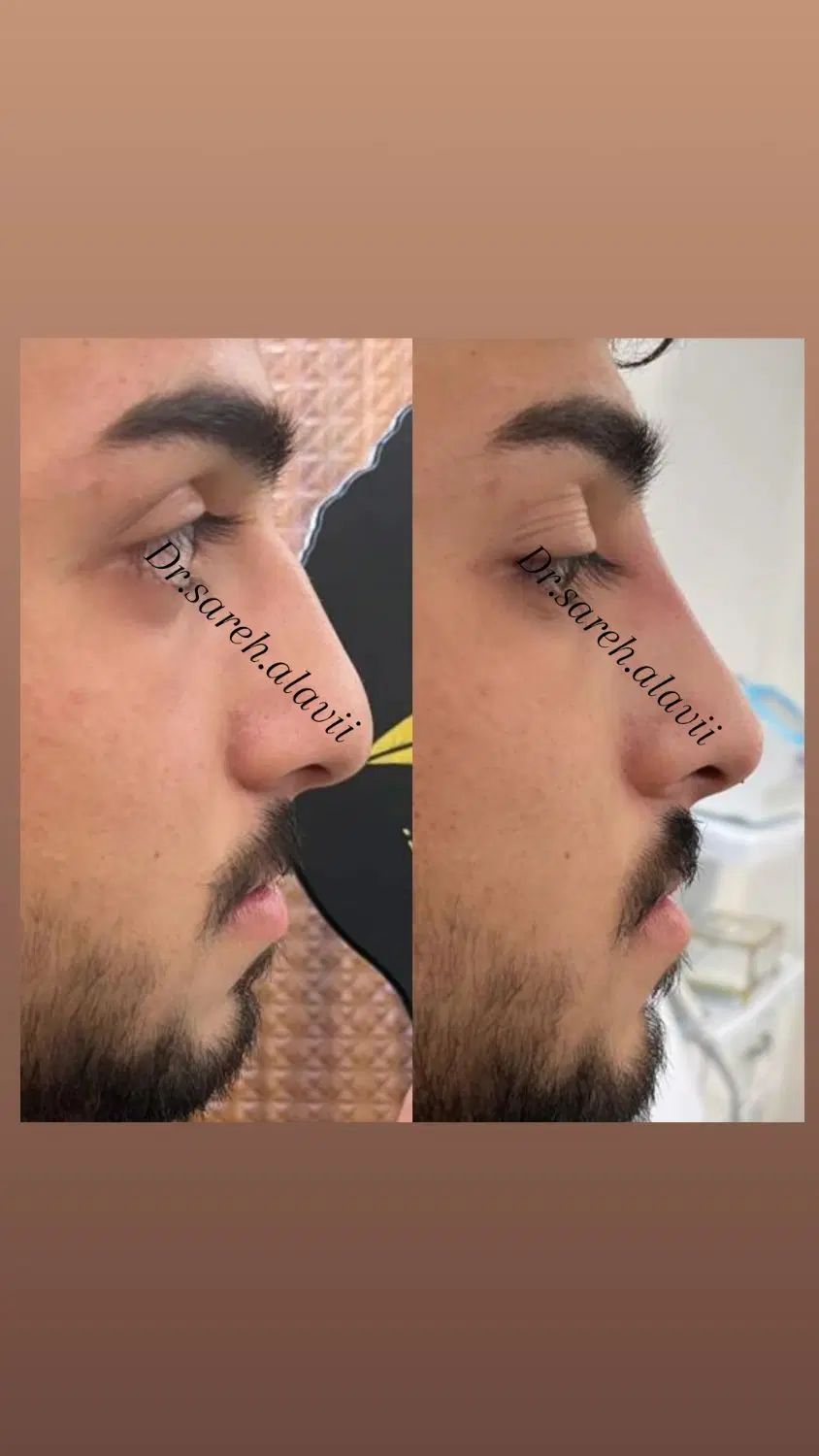 اصلاح فرم بینی بدون جراحی و بیهوشی توسط پزشک|خدمات آرایشگری و زیبایی|قم, دورشهر|دیوار