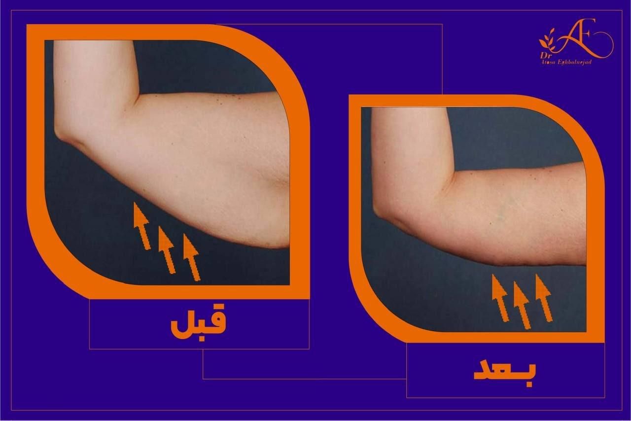 لاغری موضعی بدون جراحی و رژیم سخت|خدمات آرایشگری و زیبایی|اصفهان, سعادت‌آباد|دیوار