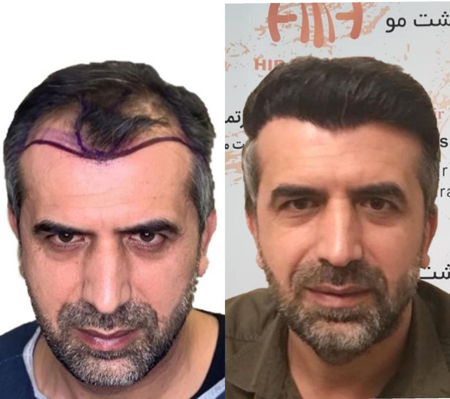 کاشت مو.ابرو.ریش درکیلنیک تخصصی|خدمات آرایشگری و زیبایی|قم, باجک دو|دیوار