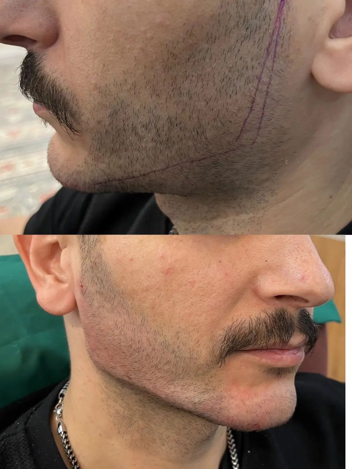 خدمات تزریق ژل و بوتاکس|خدمات آرایشگری و زیبایی|مشهد, عسگریه|دیوار