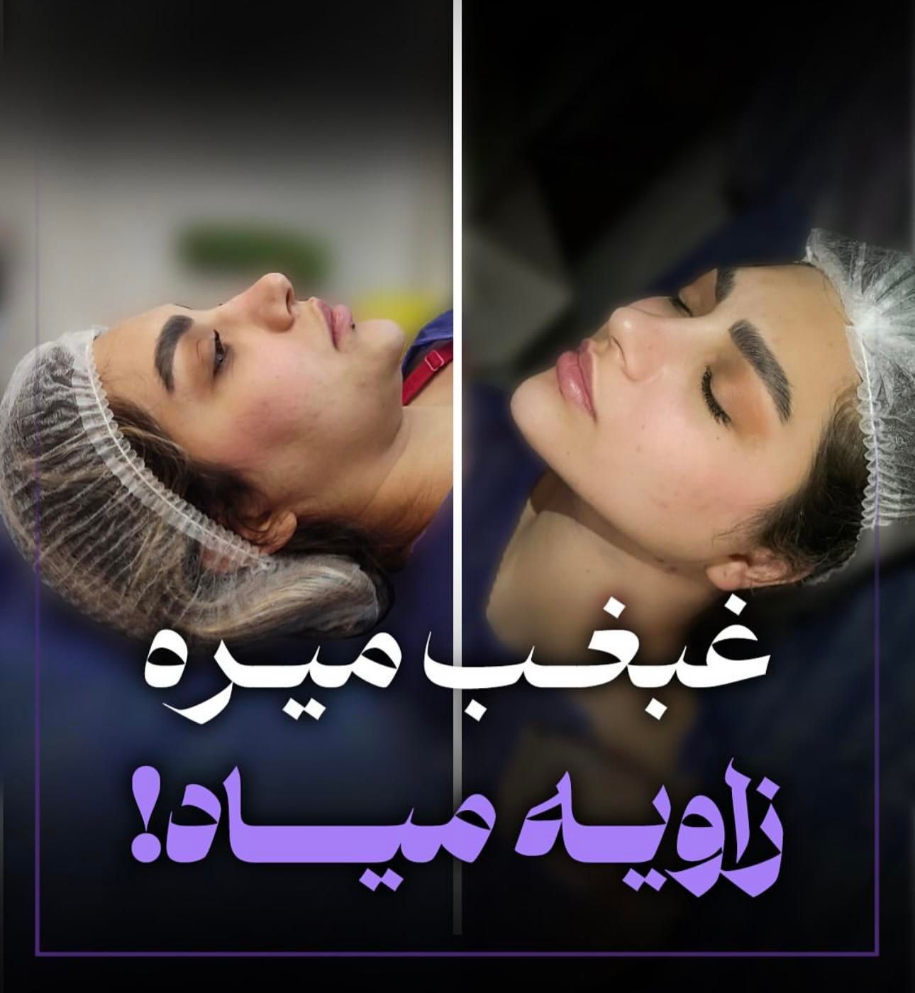ساکشن غبغب بلفارو کاشت ابرو بوکال فت|خدمات آرایشگری و زیبایی|تهران, میرداماد|دیوار