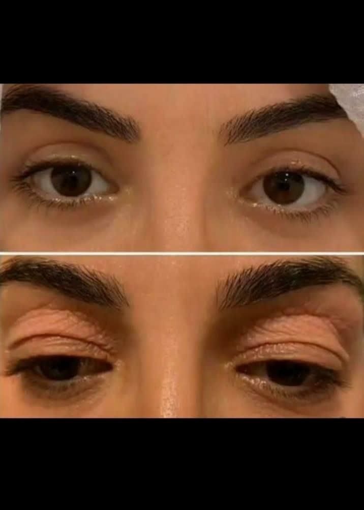 عمل رفع افتادگی پلک / رفع پف زیر چشم|خدمات آرایشگری و زیبایی|خمینی‌شهر, |دیوار