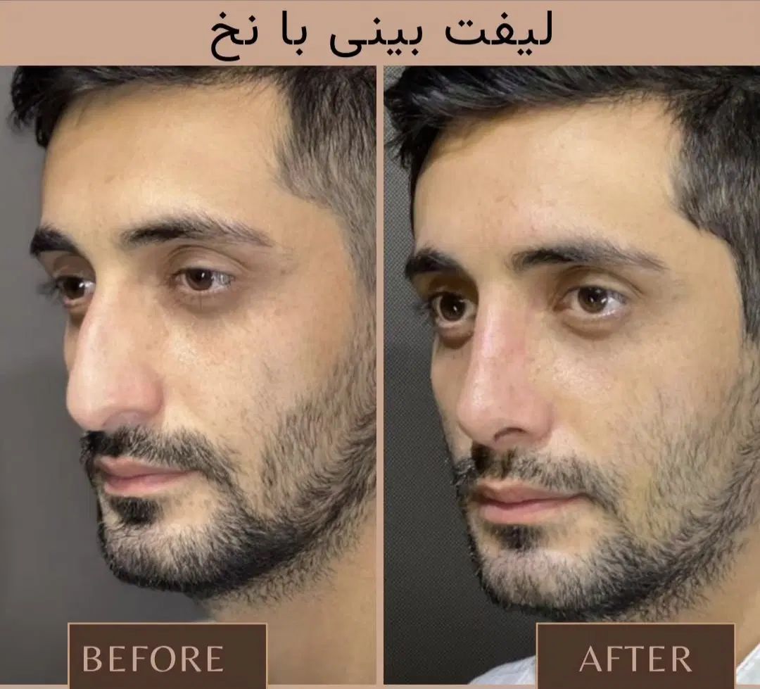 مرکز تخصصی فرم دهی و‌لیفت بینی و صورت با نخ و‌ژل|خدمات آرایشگری و زیبایی|مشهد, احمدآباد|دیوار