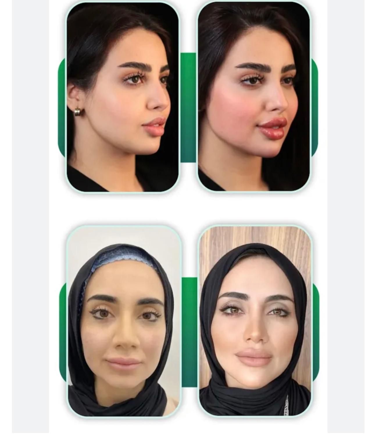 مدل تعداد محدود جهت تزریق لب روسی و کانتورینگ صورت|خدمات آرایشگری و زیبایی|تهران, زعفرانیه|دیوار