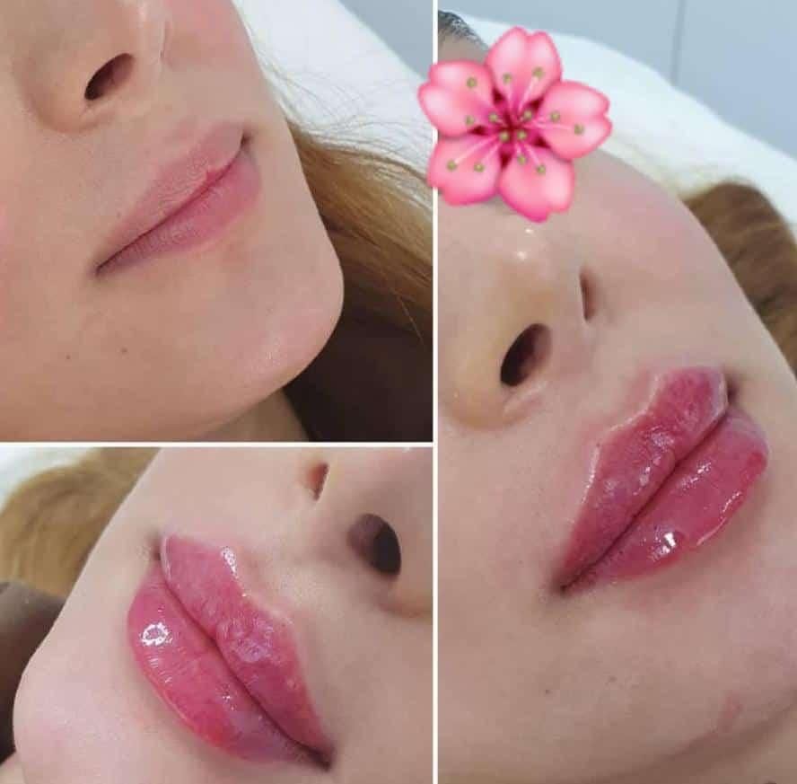 تزریق فول فیس صورت،فیلر لب وزاویه سازی|خدمات آرایشگری و زیبایی|شیراز, شهرک ایثار|دیوار