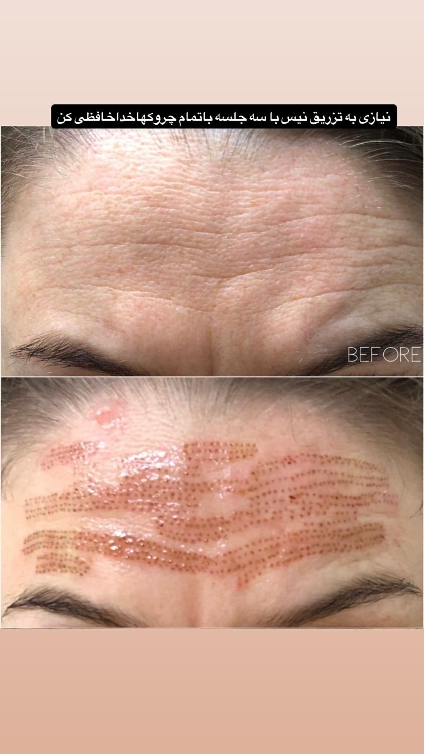 برداشتن گوشت اضافه صورت وبدن|خدمات آرایشگری و زیبایی|اصفهان, کوجان|دیوار