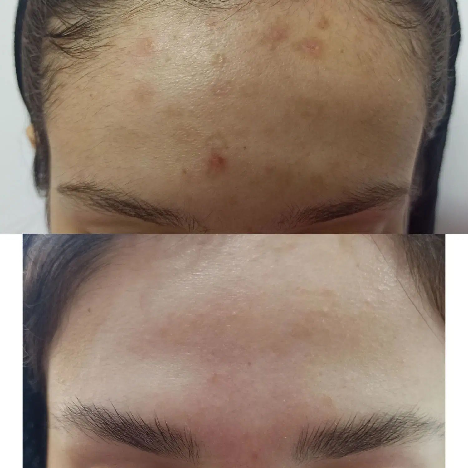 حذف لک و منافذ باز و جای جوش/زیر نظر متخصص پوست|خدمات آرایشگری و زیبایی|مشهد, الهیه|دیوار
