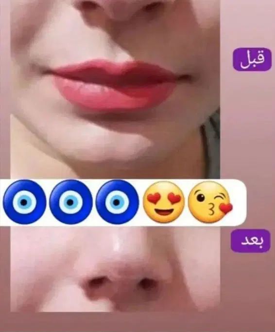 لوسیون لیفت وکوچیک کننده بینی تضمینی وبدون عوارض|آرایشی، بهداشتی، درمانی|کرمانشاه, |دیوار