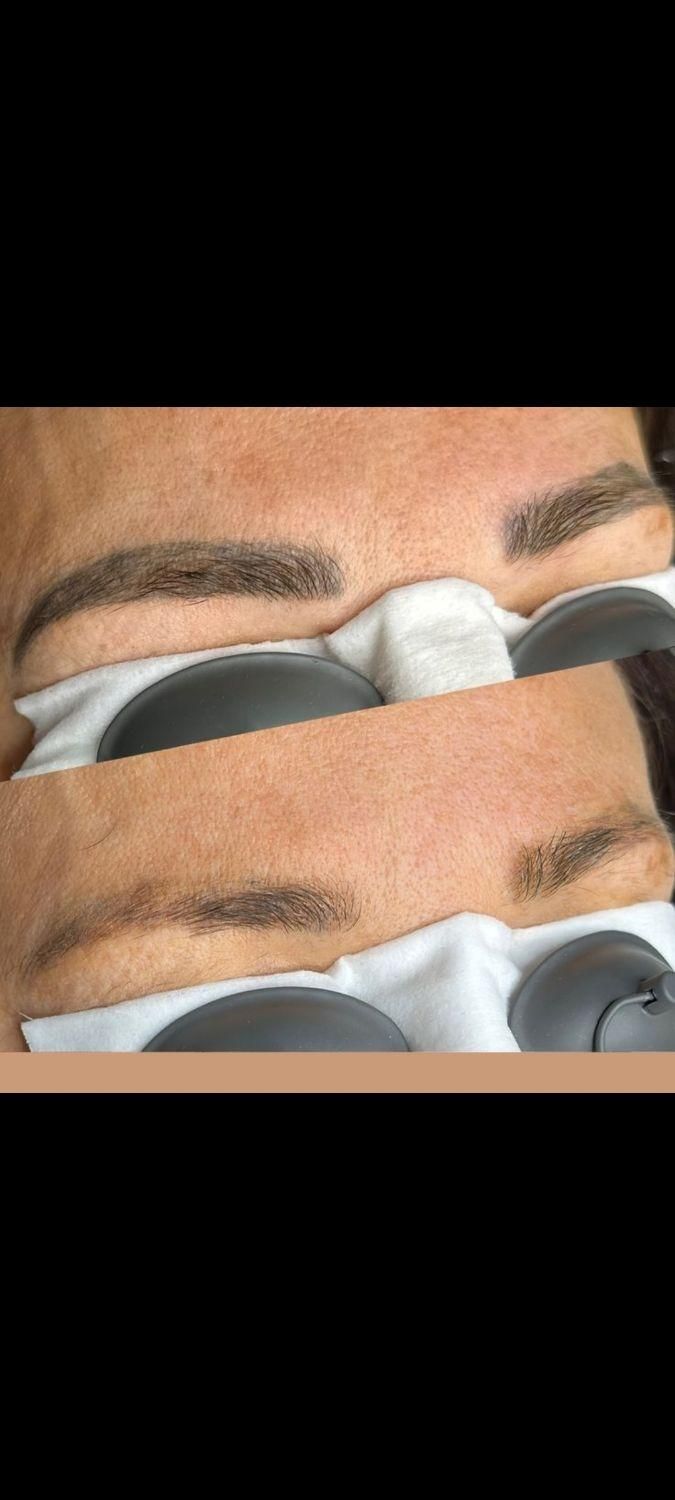 لیزر ریموو تتو در مطب پزشک و توسط پزشک|خدمات آرایشگری و زیبایی|تهران, سلسبیل شمالی|دیوار