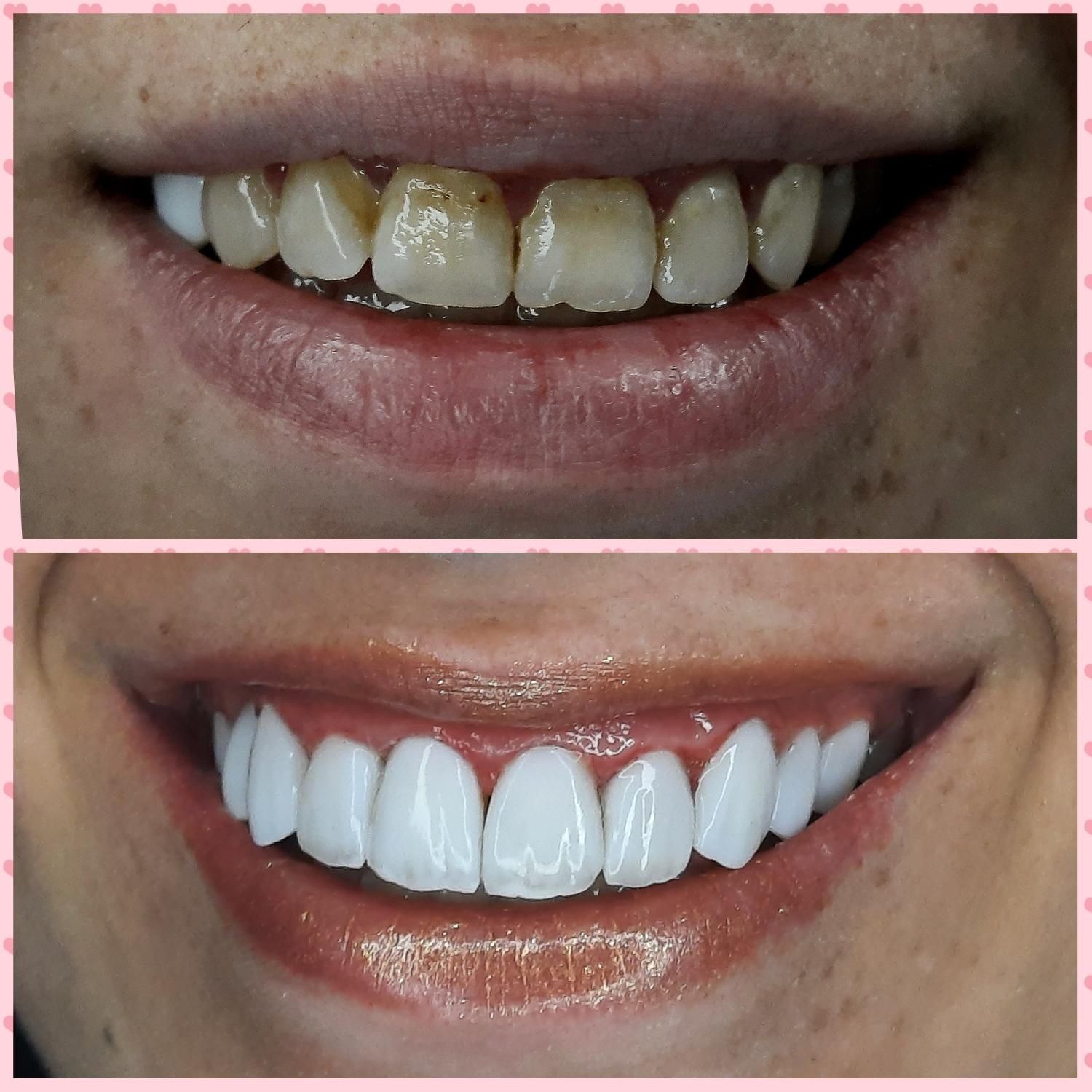 کامپوزیت دندان درمحل شمامنزل یامحل کار|خدمات آرایشگری و زیبایی|هشتگرد, شهرک گلخانه|دیوار