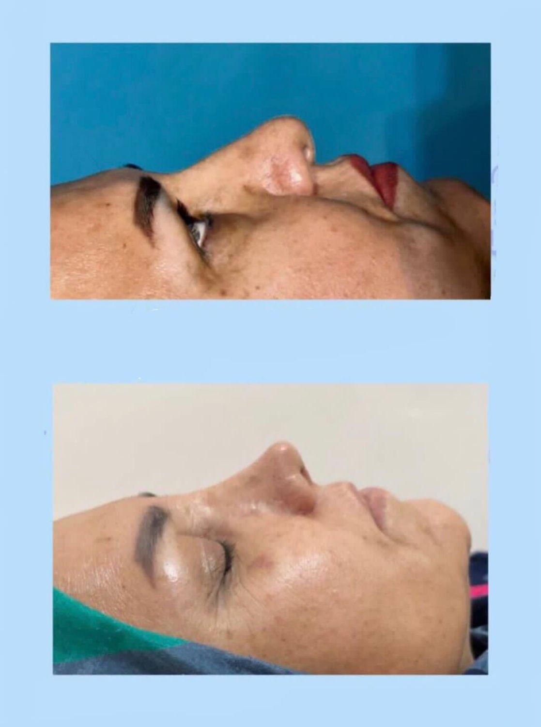 جراحی بینی با تخفیف استثنایی به مدت ۱۰روز|خدمات آرایشگری و زیبایی|بندرعباس, |دیوار