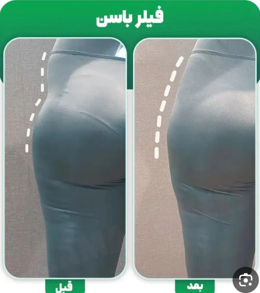 تزریق ژل وفیلر بادی و نخ و لیزر با دستگاه الکس۲۰۲۳|خدمات آرایشگری و زیبایی|تهران, تهرانپارس غربی|دیوار