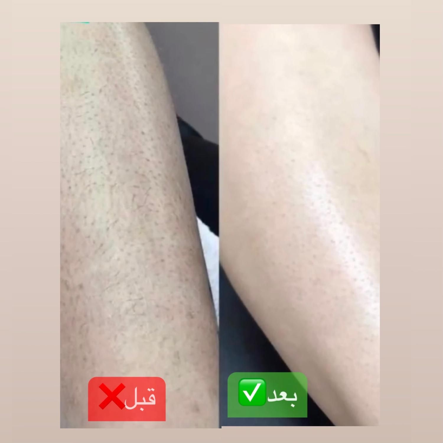 جشنواره لیزر موهای زائد سوپرانوایس تیتانیوم|خدمات آرایشگری و زیبایی|شیراز, معالی‌آباد|دیوار