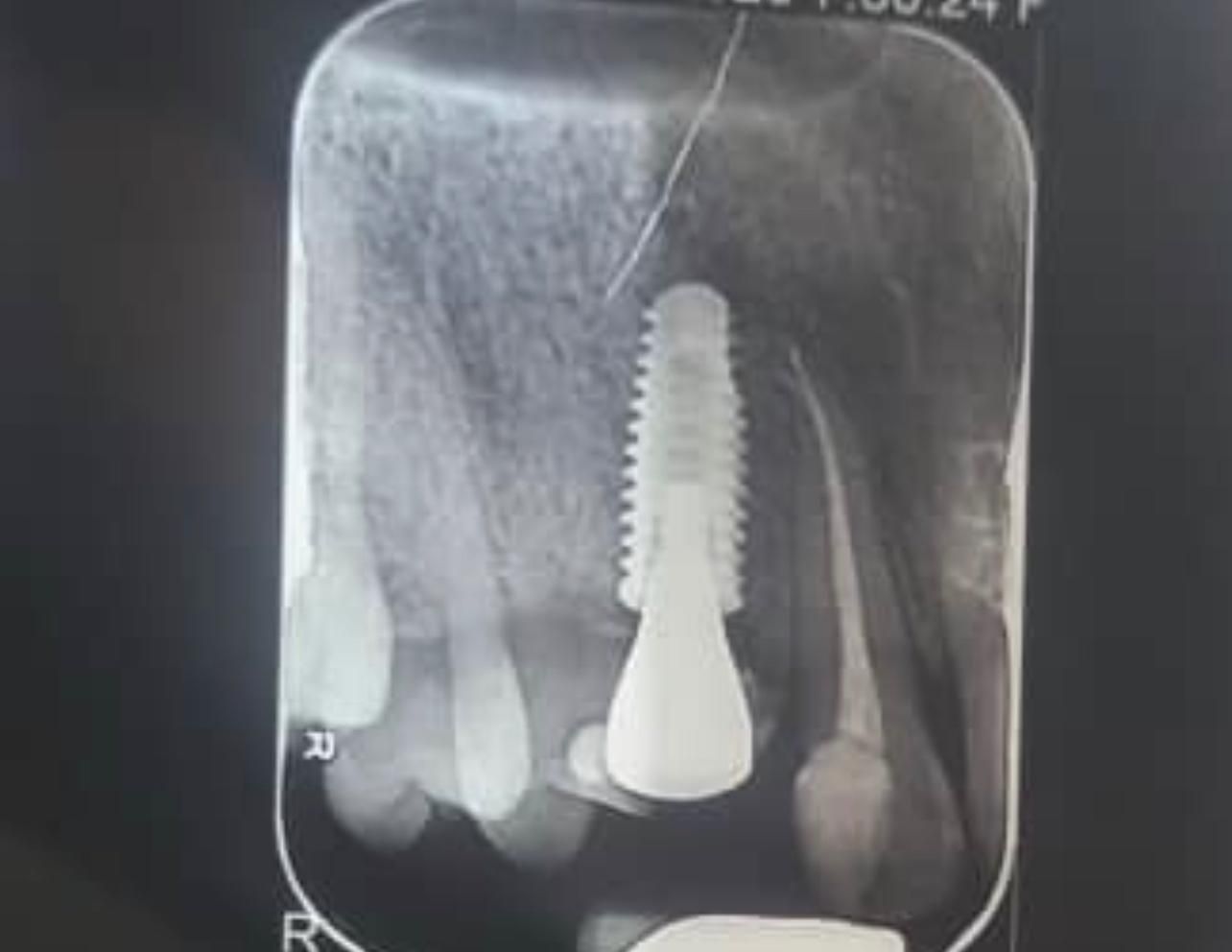 ایمپلنت با شرایط ویژه|خدمات آرایشگری و زیبایی|ارومیه, |دیوار