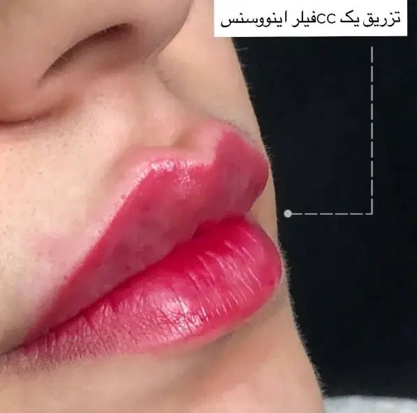 تخفیفات آنزیم بوتاکس صورت فیلر فول فیس و...|خدمات آرایشگری و زیبایی|مشهد, شهید فرامرز عباسی|دیوار