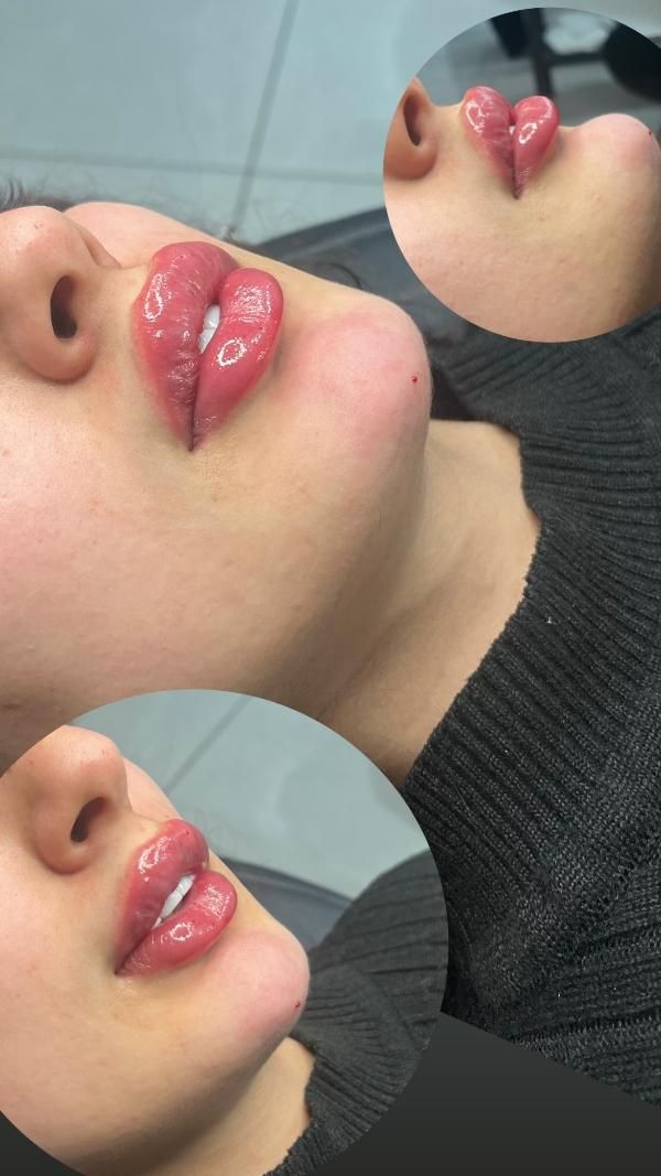 ژل بوتاکس سی سی ۵۰۰|خدمات آرایشگری و زیبایی|قرچک, میرزائی جنوبی|دیوار