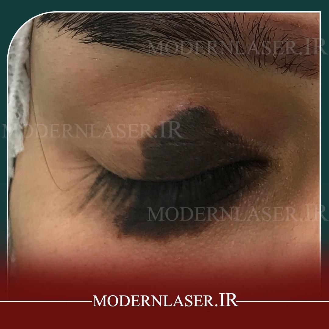 درمان کامل انواع خال و زائده های پوستی بدون بازگشت|خدمات آرایشگری و زیبایی|اصفهان, سعادت‌آباد|دیوار