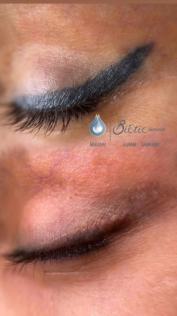 تکنیک ریموو تاتوهای قدیمی صورت و خاویارتراپی|خدمات آرایشگری و زیبایی|نیشابور, باغرود|دیوار