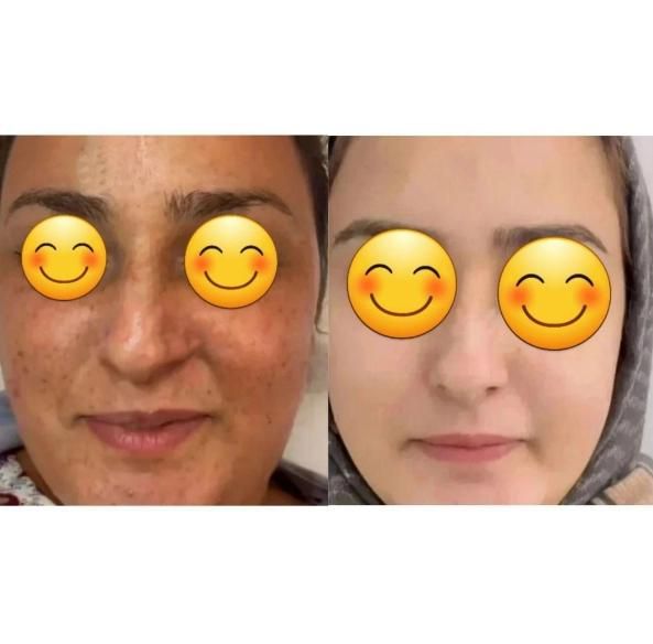 کرم ضد لک روشن کننده قوی گلدن کویین|آرایشی، بهداشتی، درمانی|شیراز, اصلاح‌نژاد|دیوار