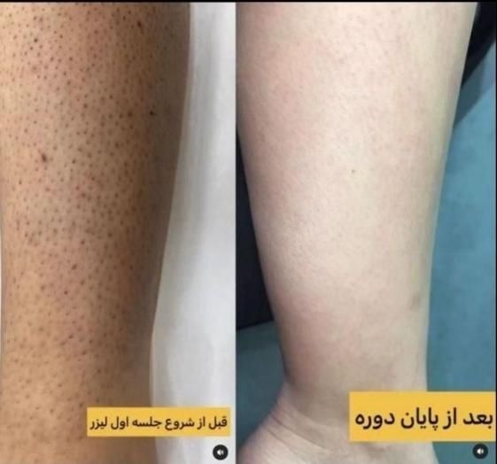 ژل وبوتاکس ولیزر وفشیال وخالبرداری ومزونیدلینگ|خدمات آرایشگری و زیبایی|تبریز, |دیوار