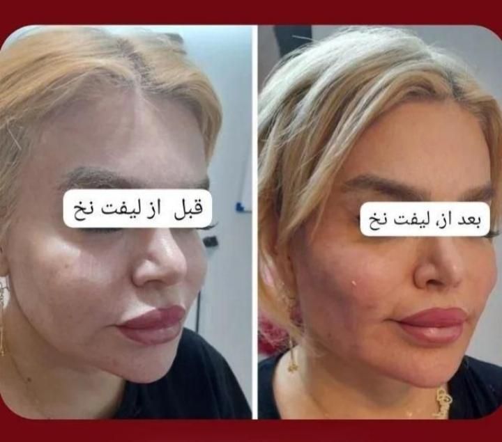لیفت نخ انزیم ژل وبوتاکس پلاسما تتوبدن فشیال...|خدمات آرایشگری و زیبایی|قم, باجک دو|دیوار
