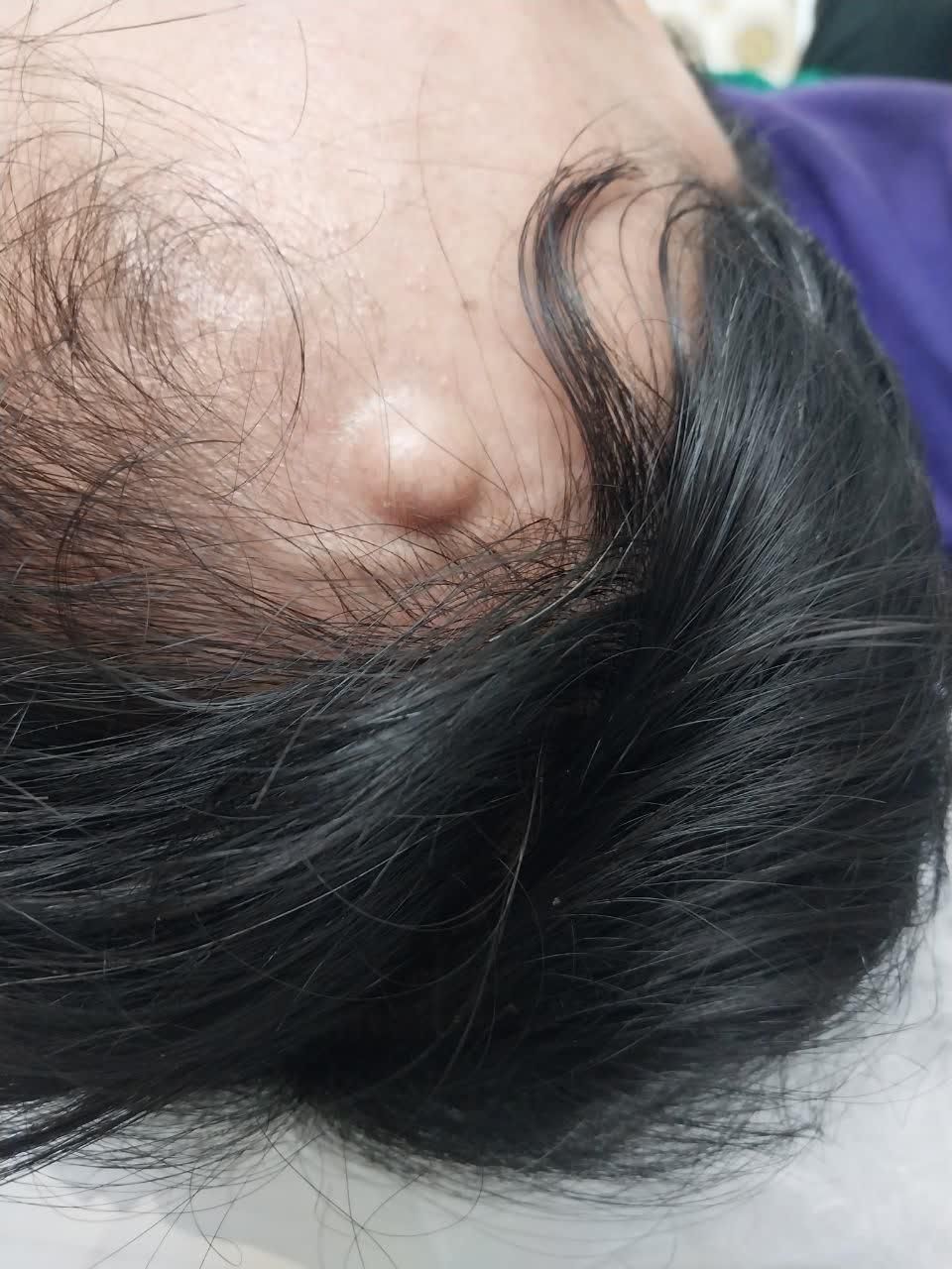 جراحی خال زگیل و میخچه و ناخن با لیزر در مطب پزشک|خدمات آرایشگری و زیبایی|قم, میرزائیه|دیوار