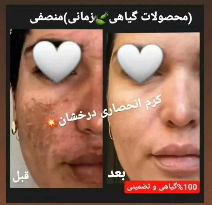 (کرم ضدلک و روشن کننده درخشان)بدون بازگشت|آرایشی، بهداشتی، درمانی|شیراز, قصرالدشت|دیوار