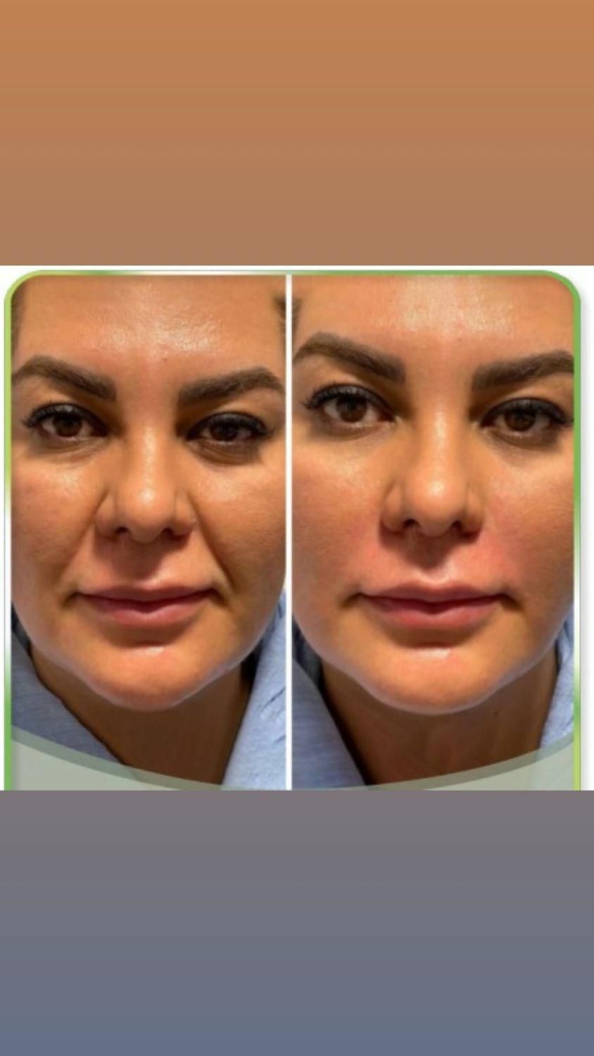 فیلر لب ، خط خنده، زاویه ، مزو فقط ۱۸۰۰|خدمات آرایشگری و زیبایی|محمدیه-قزوین, |دیوار