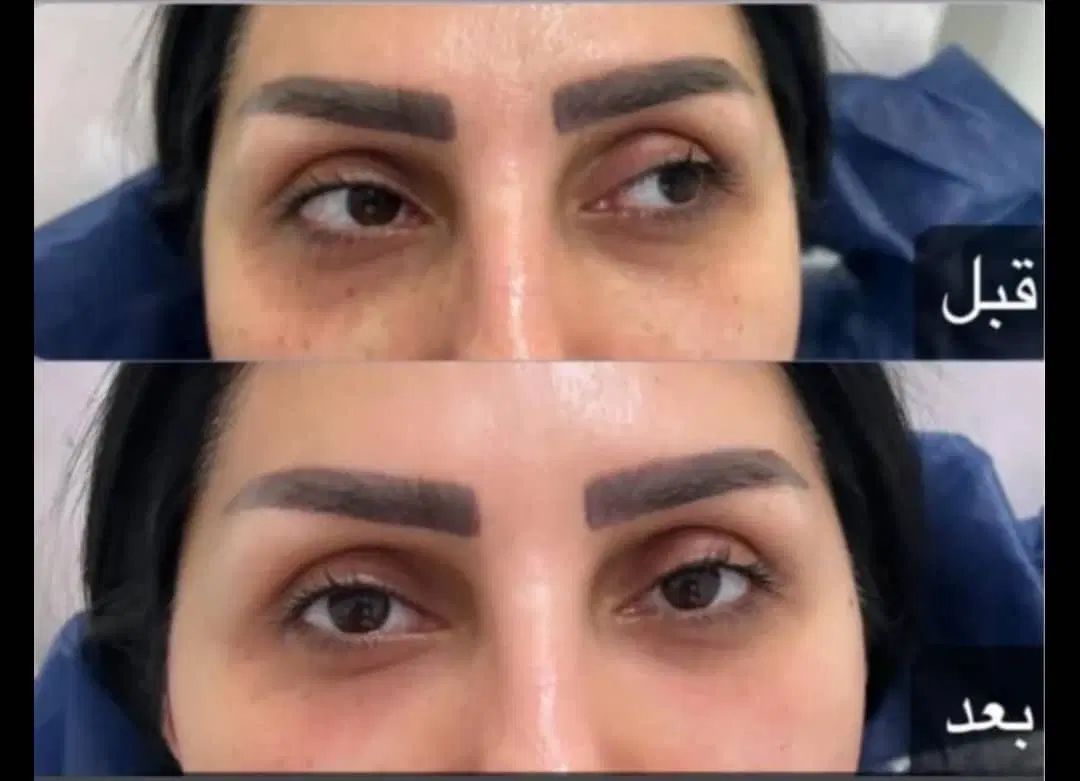 ژل و بوتاکس مزوژل مزو تخفیف ویژه تا پایان شهریور|خدمات آرایشگری و زیبایی|مشهد, فلسطین|دیوار