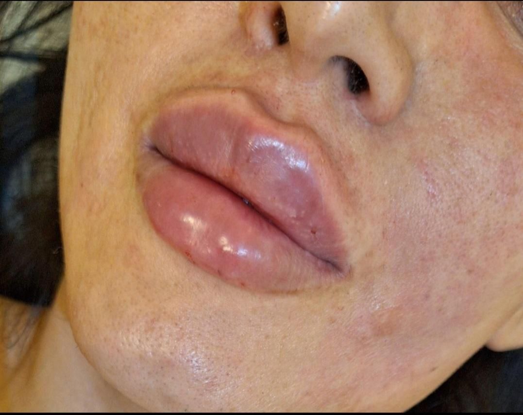 سابسیژن فیلر اندولیفت ژل بادی هایفو مزو بوتاکس|خدمات آرایشگری و زیبایی|کرج, مهرویلا جنوبی|دیوار