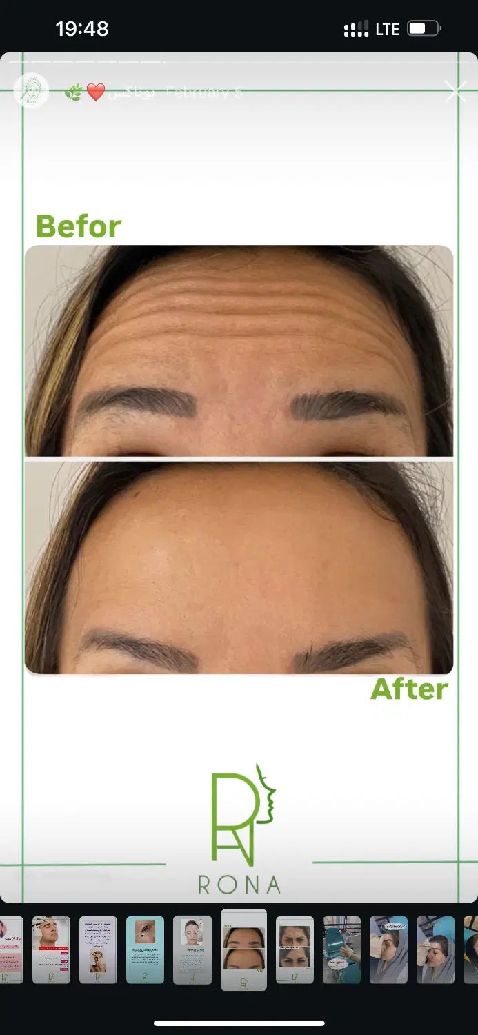 تخفیف ویژه بوتاکس فیلر فیشال لیزر فیشیال ژل|خدمات آرایشگری و زیبایی|فردیس, شهرک ۱۱۰|دیوار
