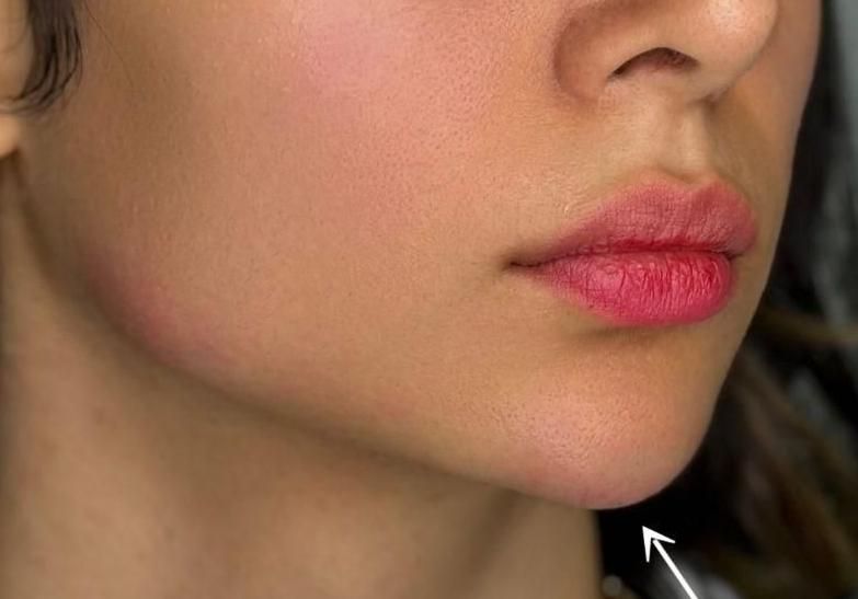 مرکز تخصصی ژل بوتاکس /کاشت امبدینگ لاغری در مطب|خدمات آرایشگری و زیبایی|کرمانشاه, |دیوار