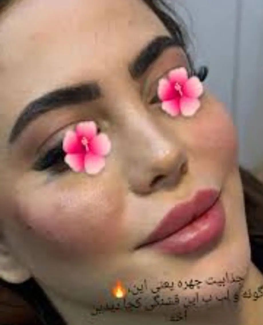 پاکسازی و جوانسازی پوست و صورت .مزو .بوتاکس چربی|خدمات آرایشگری و زیبایی|اسلام‌شهر, شهرک مصطفی خمینی|دیوار