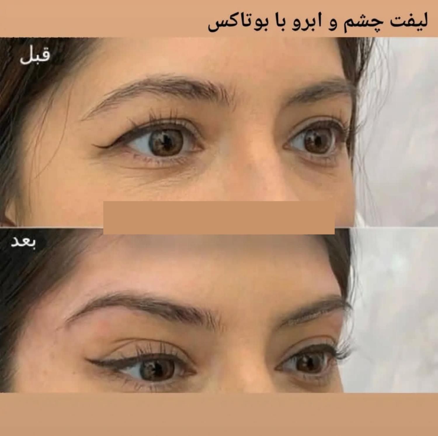 تزریق ژل بوتاکس چربیسوزی آنزیم جوانسازی|خدمات آرایشگری و زیبایی|اهواز, کیانپارس |دیوار