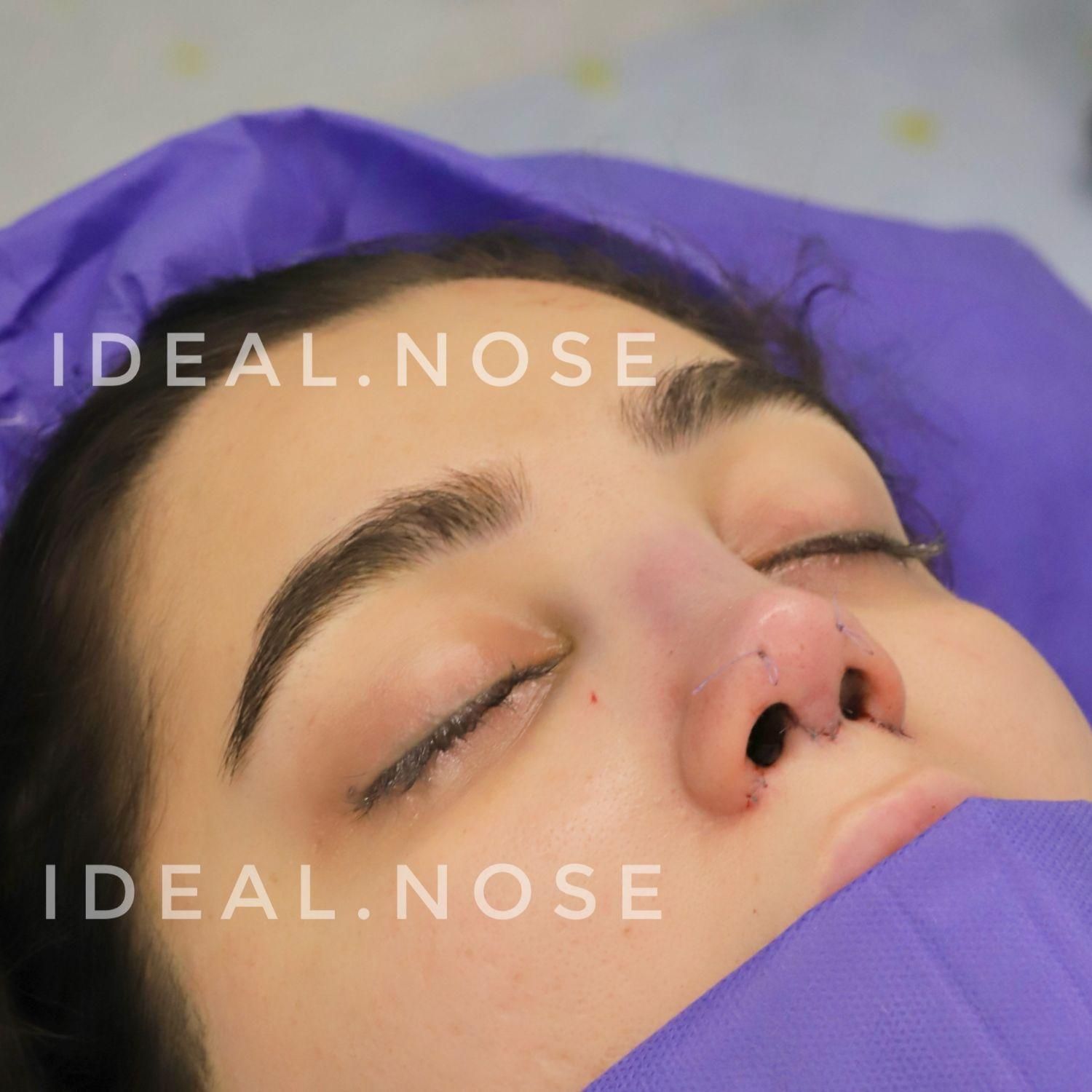 جشنواره عمل زیبایی بینی با تخفیف ویژه|خدمات آرایشگری و زیبایی|الوند, |دیوار