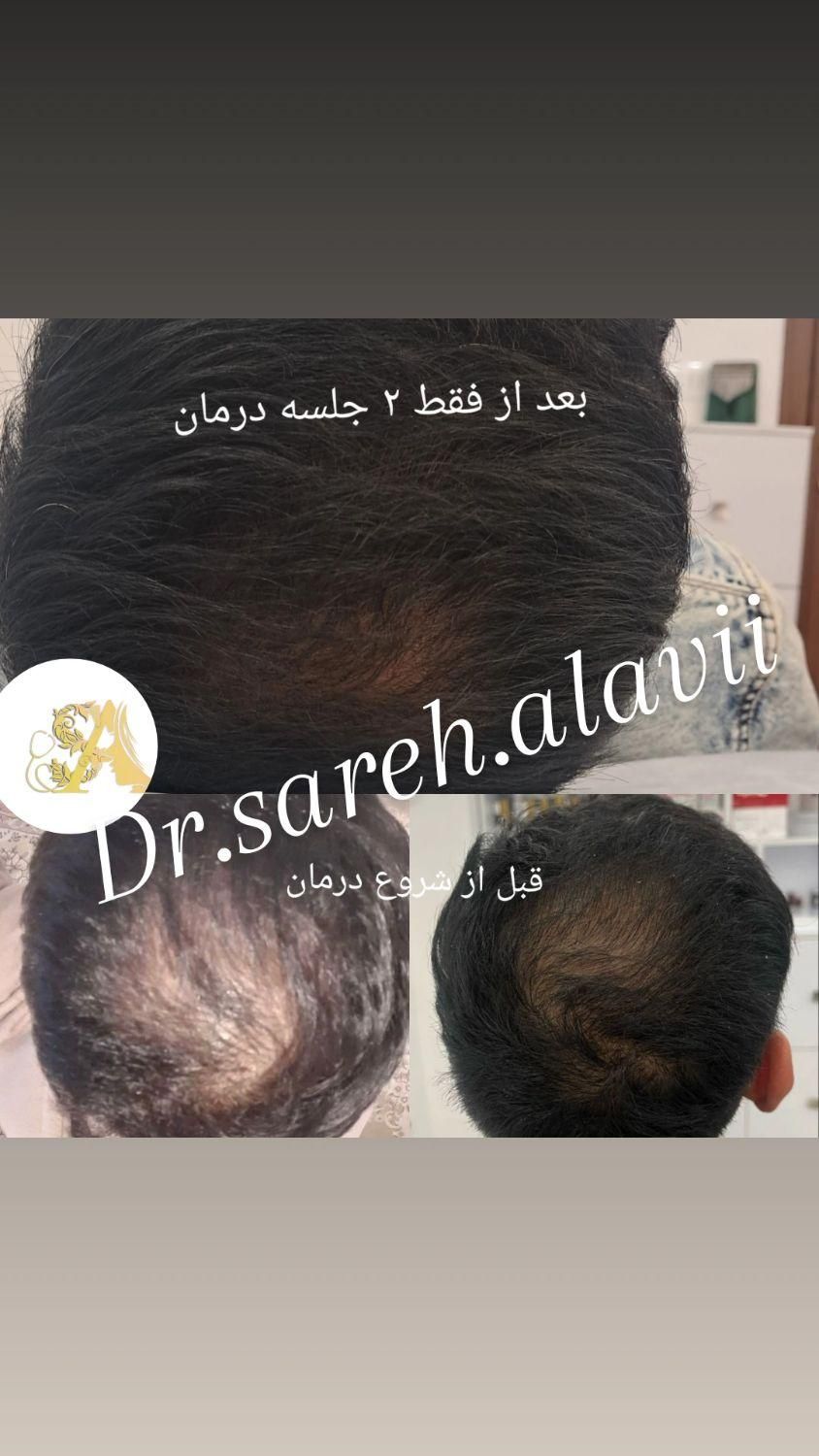 درمان ریزش مو توسط پزشک|خدمات آرایشگری و زیبایی|قم, دورشهر|دیوار