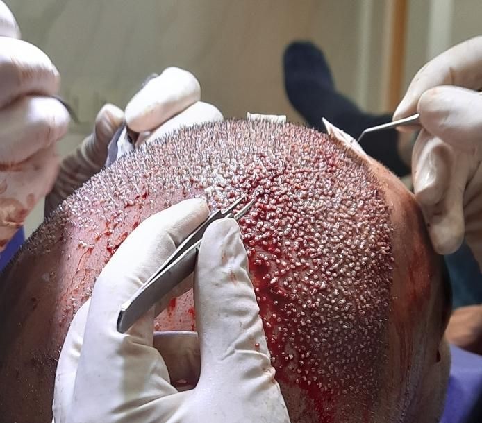 کاشت تخصصی مو و ریش،مزوتراپی،prp(تضمینی)|خدمات آرایشگری و زیبایی|اصفهان, سعادت‌آباد|دیوار