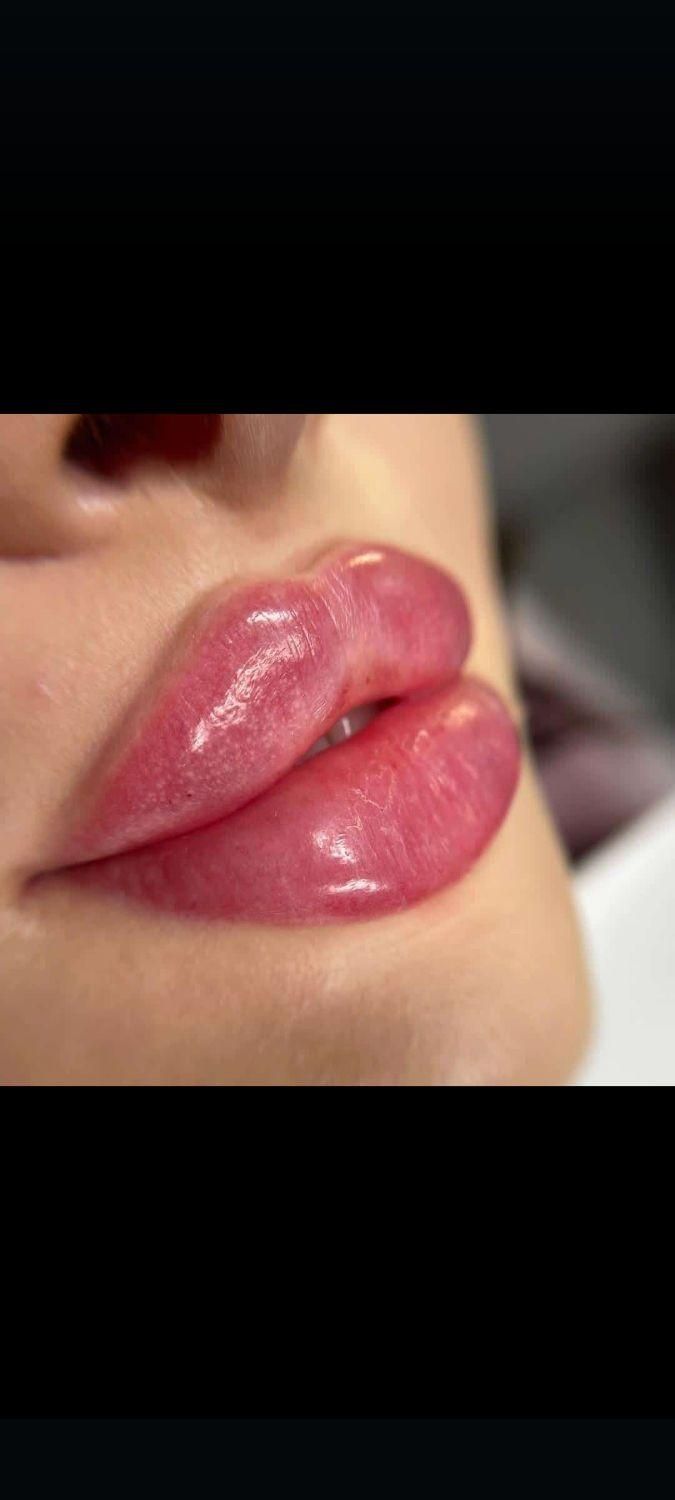 ژل بوتاکس لیزر مزو پی آر پی خالیرداری جوانسازی|خدمات آرایشگری و زیبایی|تهران, افسریه|دیوار