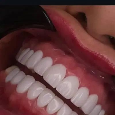 کامپوزیت دندان/اقساط/آف ویژه|خدمات آرایشگری و زیبایی|اصفهان, جلفا|دیوار
