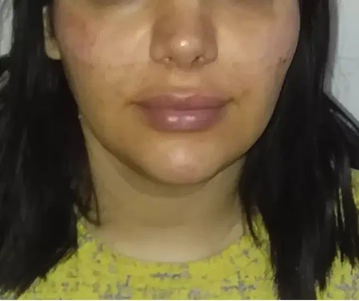 تزریق ژل وبوتاکس ژل لب گونه چانه زاویه خط لبخند|خدمات آرایشگری و زیبایی|کرمانشاه, |دیوار