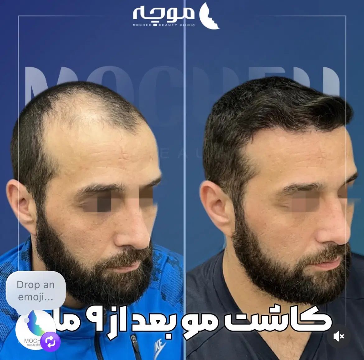 کاشت مو بدون جراحی یک روزه ضمانت مادام العمر|خدمات آرایشگری و زیبایی|تهران, ونک|دیوار