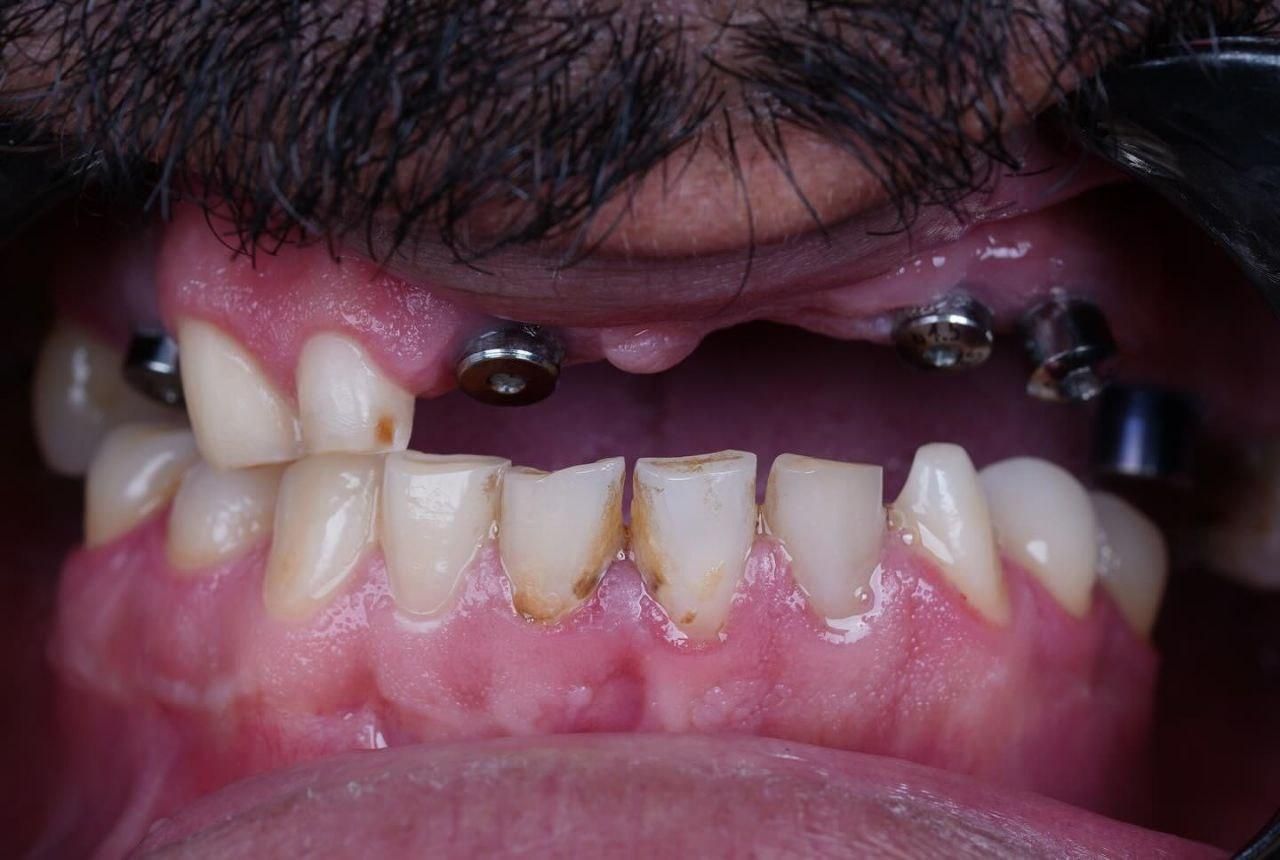 دندانپزشکی ایمپلنت کامپوزیت لمینیت روکش دندان|خدمات آرایشگری و زیبایی|تبریز, |دیوار