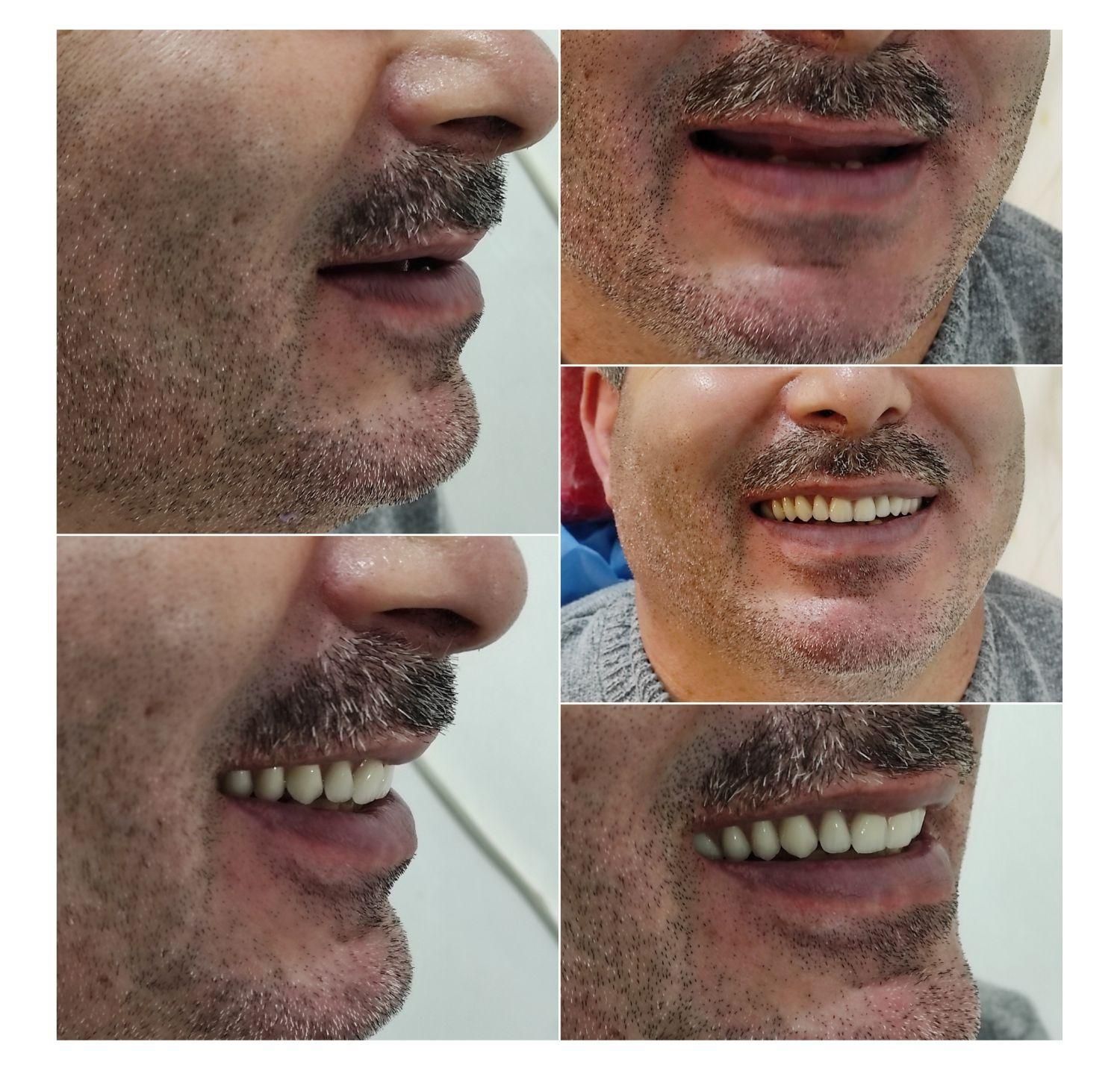 خدمات دندان مصنوعی (پروتز متحرک)|آرایشی، بهداشتی، درمانی|پارسآباد, |دیوار