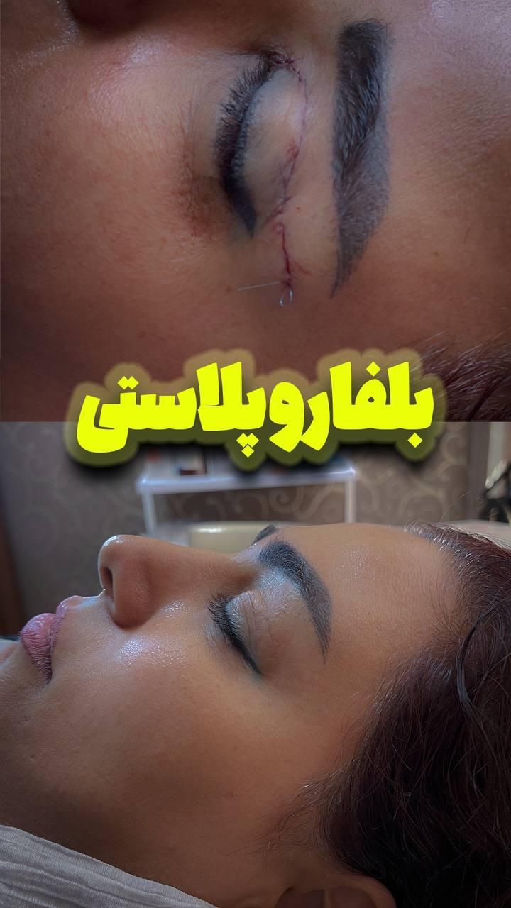 جشنواره بلفاروساکشن غبغب فقط۵/۷۰۰|خدمات آرایشگری و زیبایی|تهران, جردن|دیوار