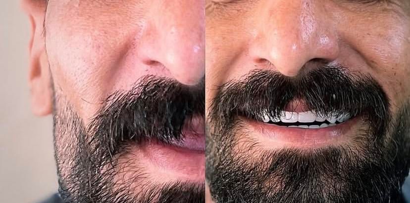 دندانسازی مصنوعی دندان مصنوعی با کیفیت و زیبا|خدمات آرایشگری و زیبایی|تبریز, |دیوار