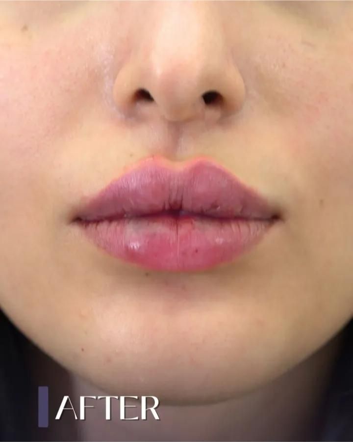 تزریق ژل و بوتاکس جشنواره عید|خدمات آرایشگری و زیبایی|تهران, عبدل‌آباد|دیوار