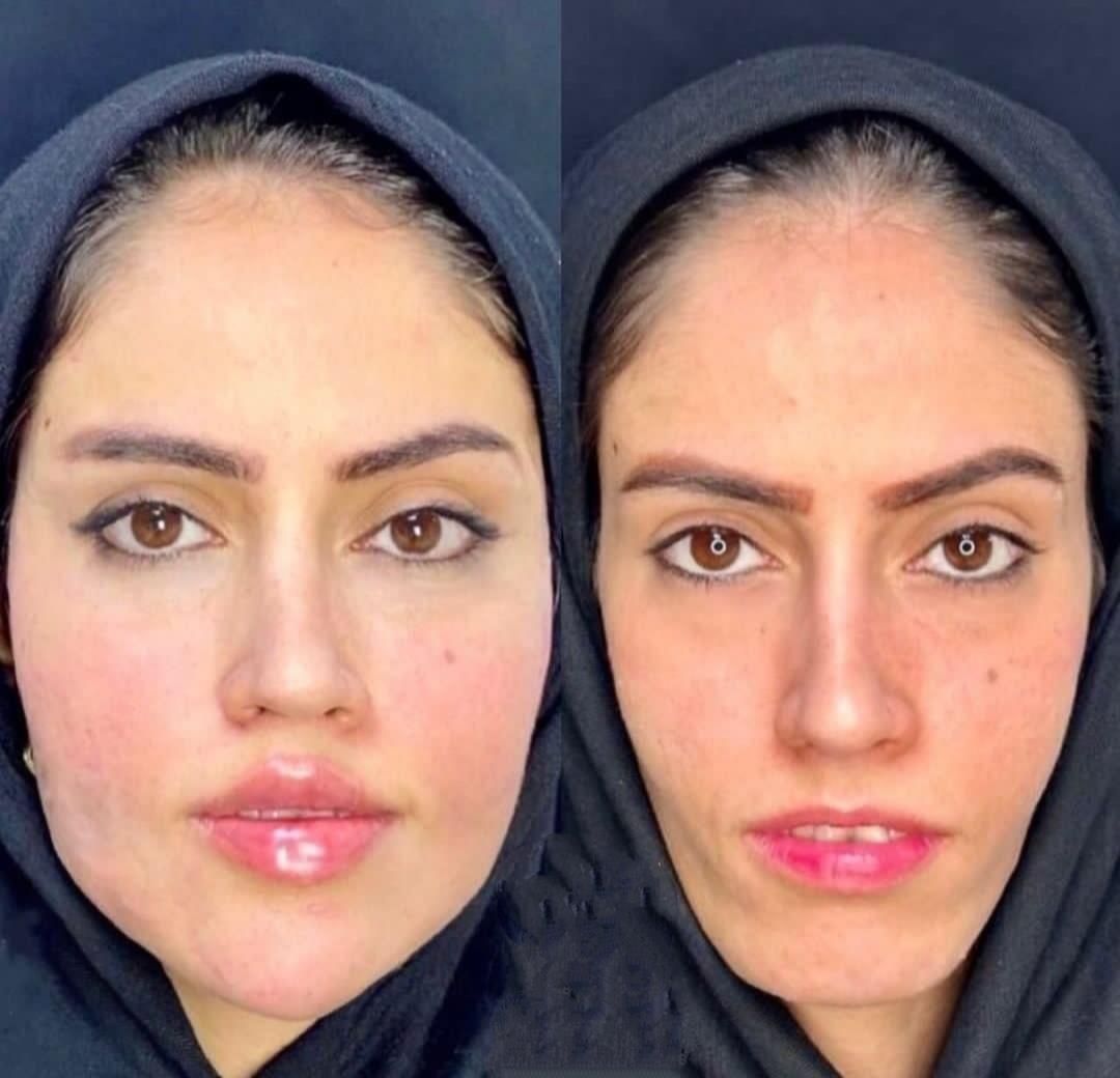 جشنواره باور نکردنی ویژه. ژل و بوتاکس.فیلر مزو ژل|خدمات آرایشگری و زیبایی|شیراز, سینما سعدی|دیوار