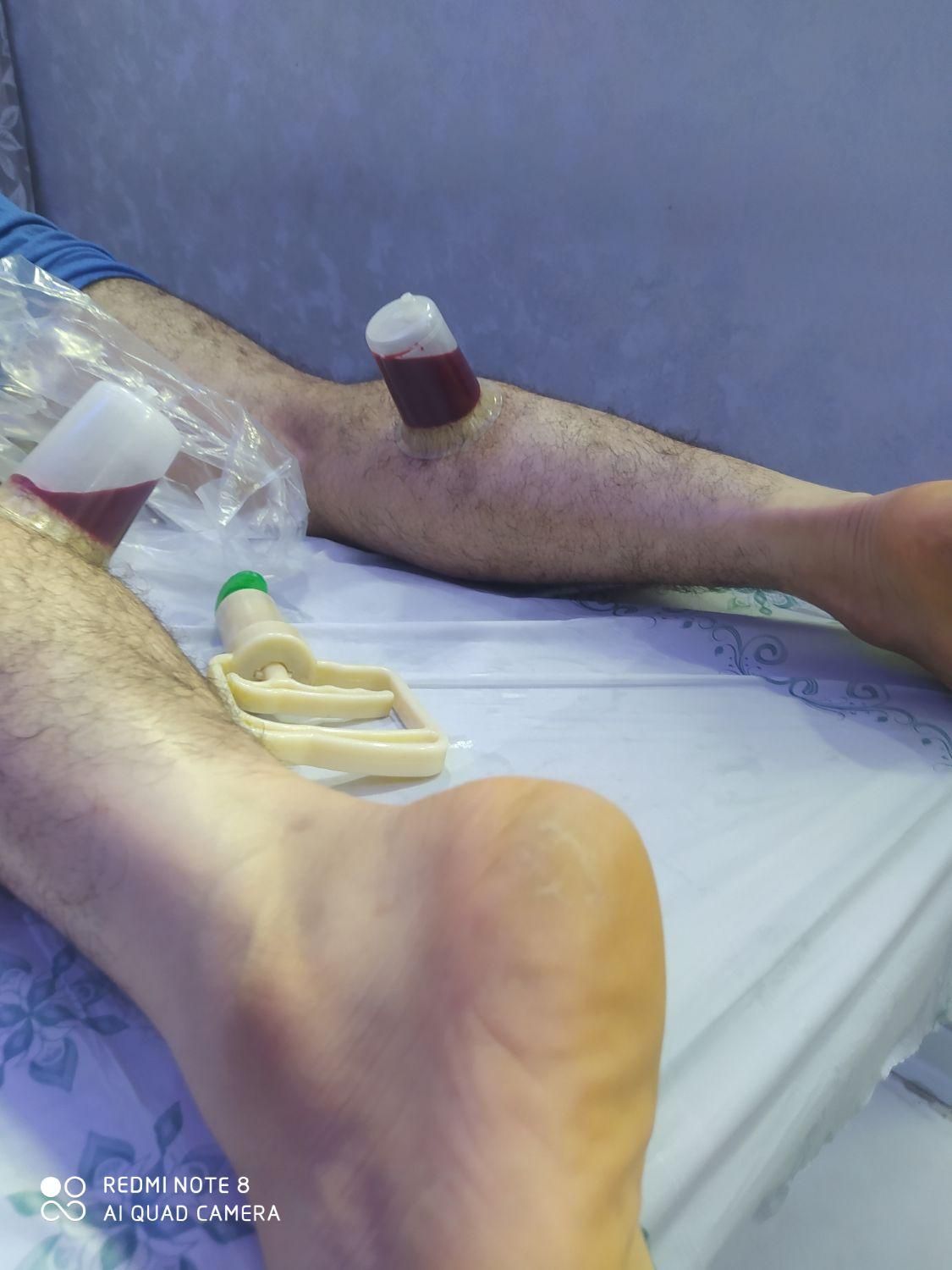 حجامت درمانی فیزیوتراپی وروغن و بادکش ورزشی|خدمات آرایشگری و زیبایی|اندیمشک, |دیوار